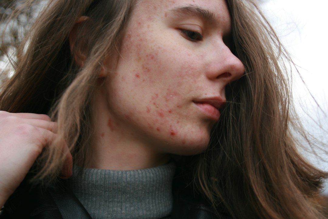 Young person with clear, healthy skin after acne treatment, warm natural light, authentic and real